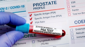 Mi PSA es alto: ¿Significa eso que tengo cáncer de próstata?