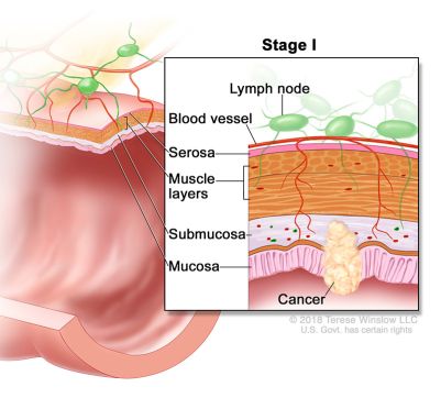 cáncer colorrectal etapa 1 ilustración