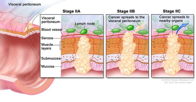 cáncer colorrectal etapa 2 ilustración