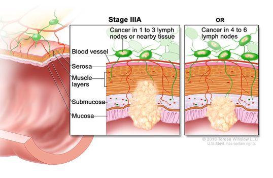 cáncer de colon y recto en estadio 3a