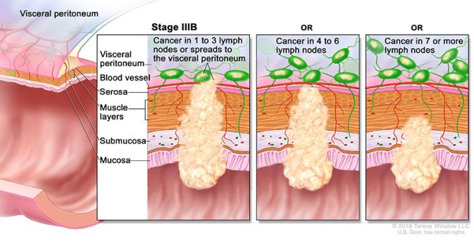 cáncer de colon y recto en estadio 3b