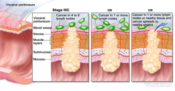 cáncer de colon y recto en estadio 3c