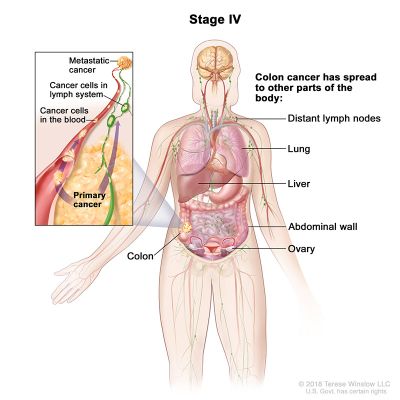 cáncer colorrectal etapa 4 ilustración