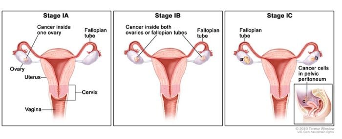 estadio 1 cáncer de ovario 1a 1b 1c estadio cáncer de ovario