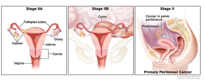 cáncer de ovario en estadio 2 2a 2b 2c estadio del cáncer de ovario