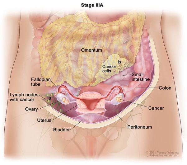 cáncer de ovario estadio3a