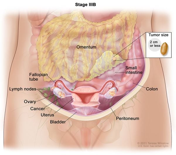 cáncer de ovario en estadio 3b