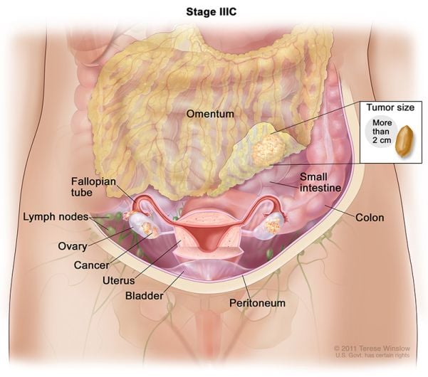 cáncer de ovario estadio 3c