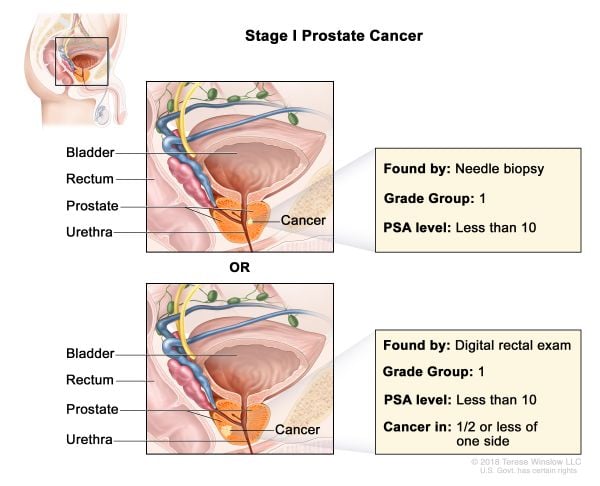 Cáncer de próstata estadio 1
