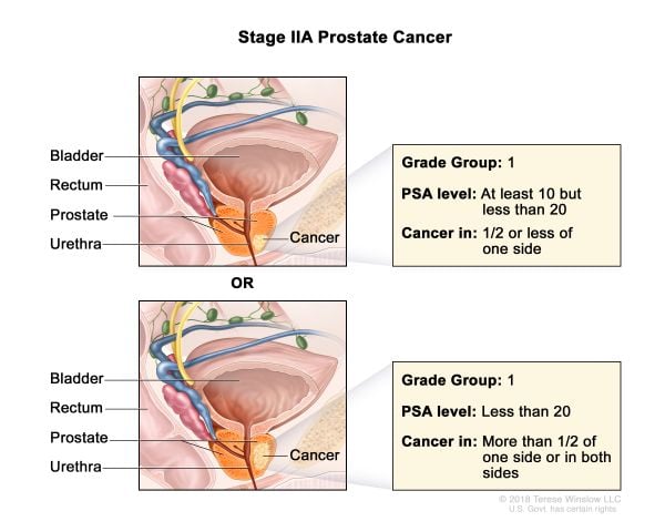 Cáncer de próstata estadio 2A
