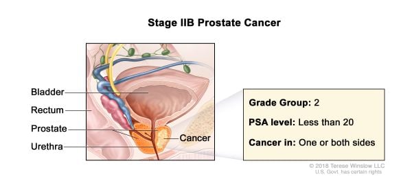Cáncer de próstata estadio 2b