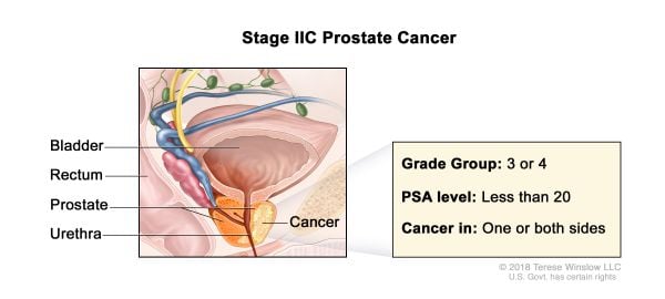 Cáncer de próstata estadio 2c