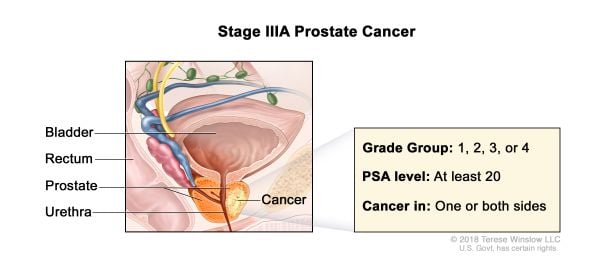 Cáncer de próstata estadio 3a
