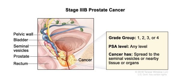 Cáncer de próstata estadio 3b