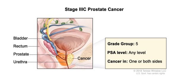 Cáncer de próstata estadio 3c
