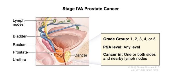 Cáncer de próstata estadio 4A