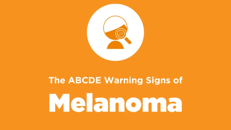 ABCDE Signos de advertencia del melanoma